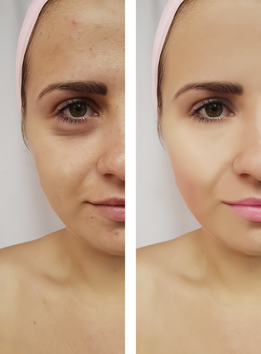 beautiful girl face wrinkles before and after procedures