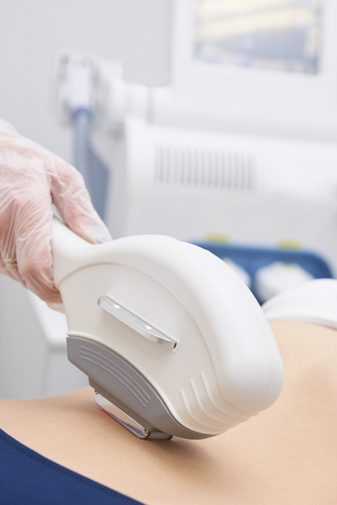 Laser hair removal. Hair removal on the body. Bright skin. Medical procedure